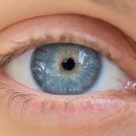 Glaucoma