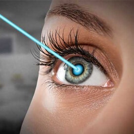 Lasik